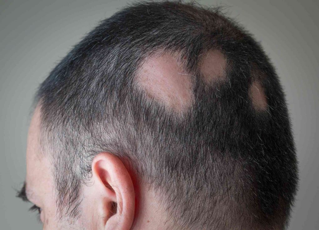 Beispiel für Alopecia areata