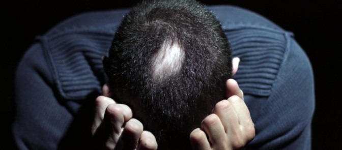 Alopecia areata während der Erkrankung
